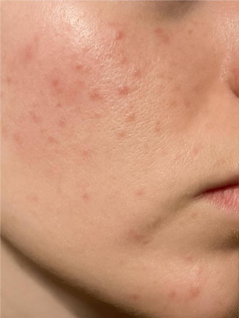 Close-up of a person's face with visible acne on the skin.